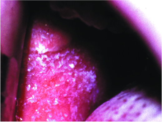 Koplik spots on buccal mucosa. (Courtesy of Pediatr Rev)