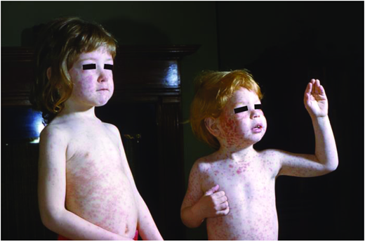 Siblings with rubella. (Courtesy of CDC)