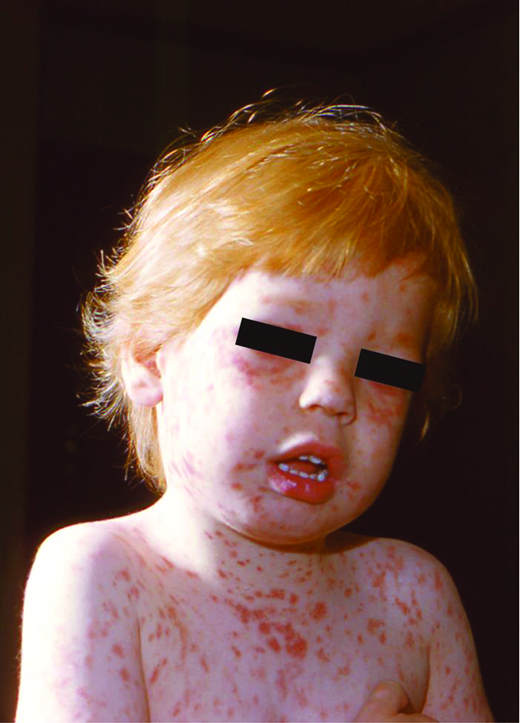 Rubella. (Courtesy of CDC)