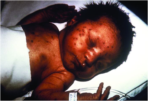 Congenital rubella: “blueberry muffin” rash. (Courtesy of CDC)