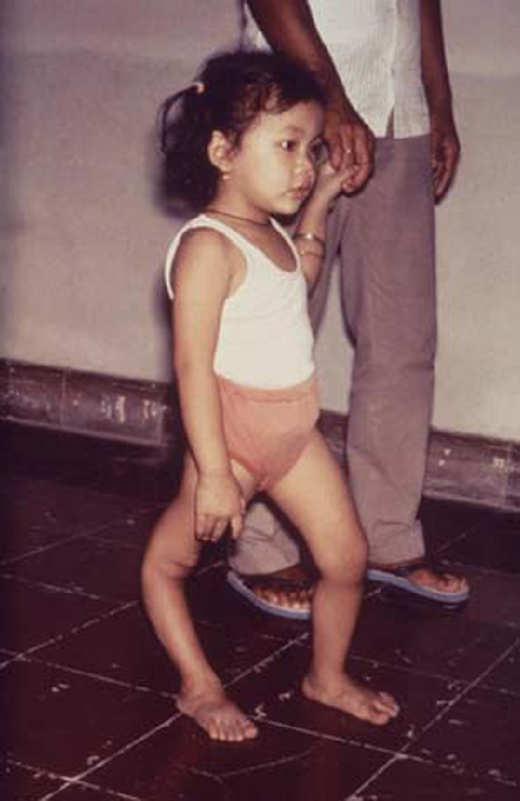 Post-paralytic polio right leg deformity. (Courtesy of CDC)