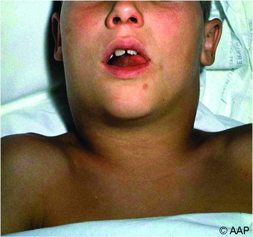 Bull neck. (Courtesy of AAP Red Book)