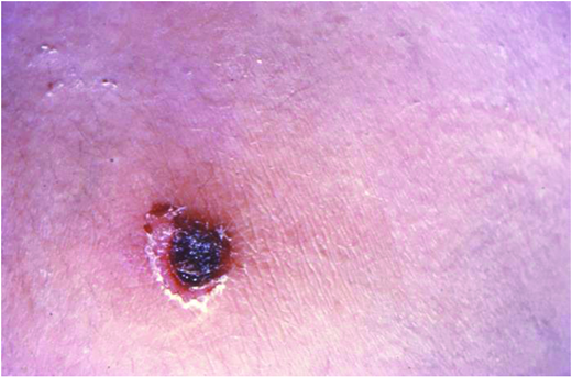 Cutaneous diphtheria. (Courtesy of CDC)