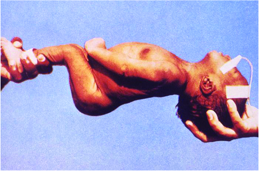 Neonatal tetanus with opisthotonus. (Courtesy of CDC)