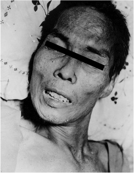 Rictus – risus sardonicus. (Courtesy of CDC)