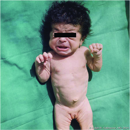 Neonatal tetanus: trismus and muscle spasms. (Courtesy of AAP Red Book)