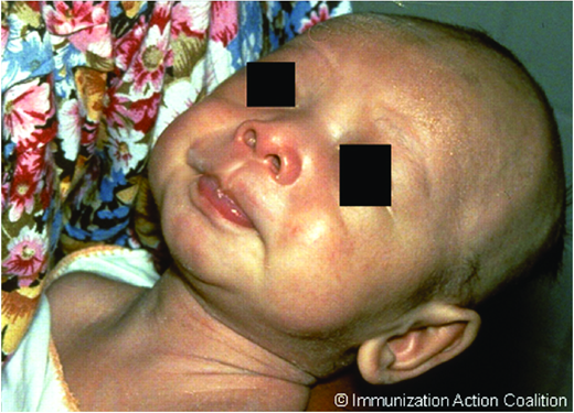 Neonatal tetanus: trismus. (Courtesy of AAP Red Book)