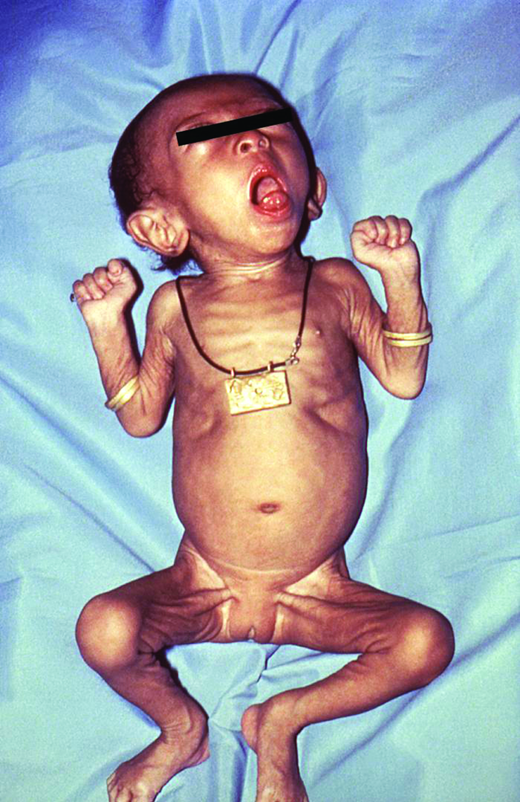 Severe coughing. (Courtesy of CDC)