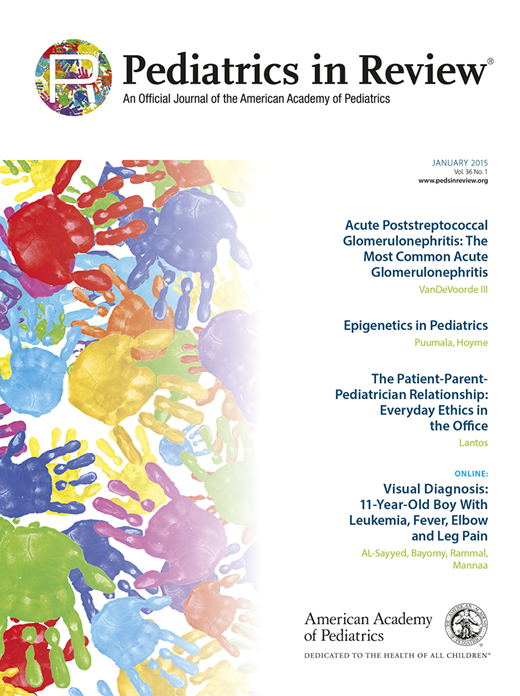 Acute Poststreptococcal Glomerulonephritis The Most Common Acute